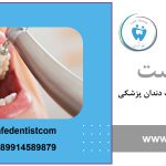 پولیش دندان و مزایا و معایب آن برای سلامتی دندان 15 پولیش دندان چیست