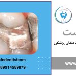 آمالگام دندان چیست؟
