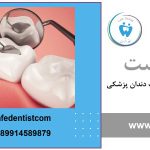 بهترین مواد پر کردن دندان