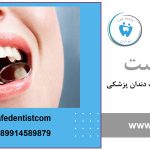 گلاس آینومر