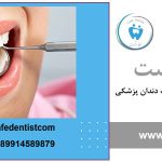 عوارض کامپوزیت دندان