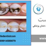 Amalgam or composite main آمالگام یا کامپوزیت؟