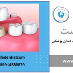 بیلداپ دندان و پرکننده آمالگام