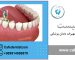 گوتا پرکا در دندانپزشکی چیست ؟