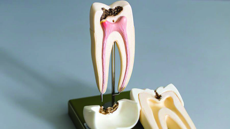 فرق بین کانال و ریشه دندان