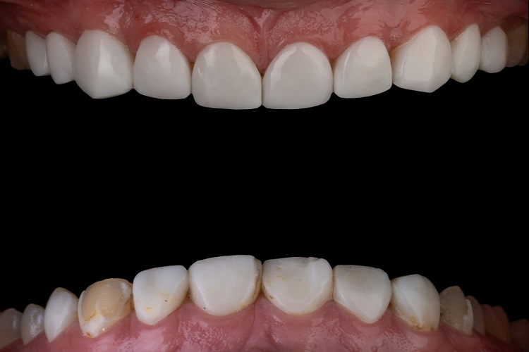پانسمان دندان