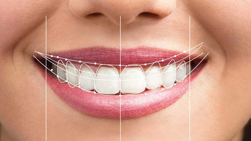پالیش کامپوزیت دندان
