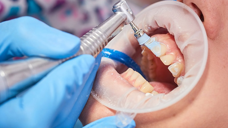 پالیش کامپوزیت دندان