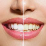 نحوه پولیش دندان کامپوزیت شده در خانه