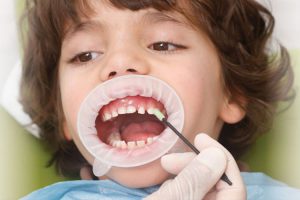 وارنیش دندان چیست؟ آشنایی با کاربرد و فواید