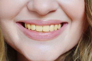 علت زردی دندان چیست؟ نحوه از بین بردن زردی دندان
