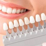 شاخص 2 لمینت دندان چیست