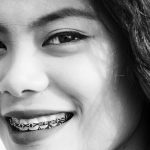 علت شکستن براکت ارتودنسی و راهکار های آن