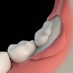 Partially impacted wisdom tooth