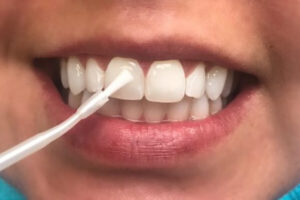 لاک سفید کننده دندان خانگی چیست؟