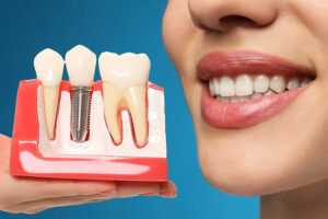 مزایا و معایب ایمپلنت دندان کدامند؟