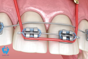 ارتودنسی دو دندان جلو و نکات مربوط به آن