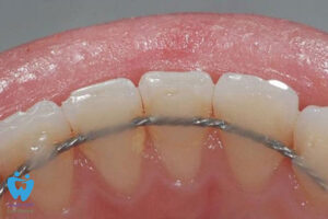 اسپلینت دندان چیست و چه کاربردی دارد؟