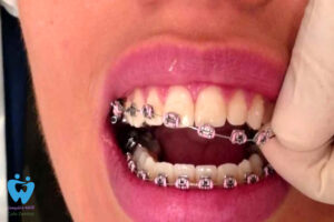 عوارض ارتودنسی دندان چیست؟ آشنایی با معایب ارتودنسی