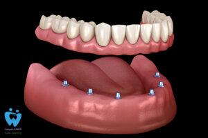 اوردنچر دندان چیست و چگونه انجام می‌شود؟