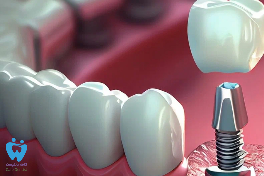 انواع اباتمنت ایمپلنت