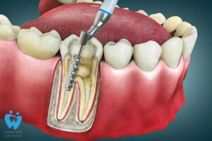 پالپکتومی چیست و چه تفاوتی با پالپوتومی دارد؟