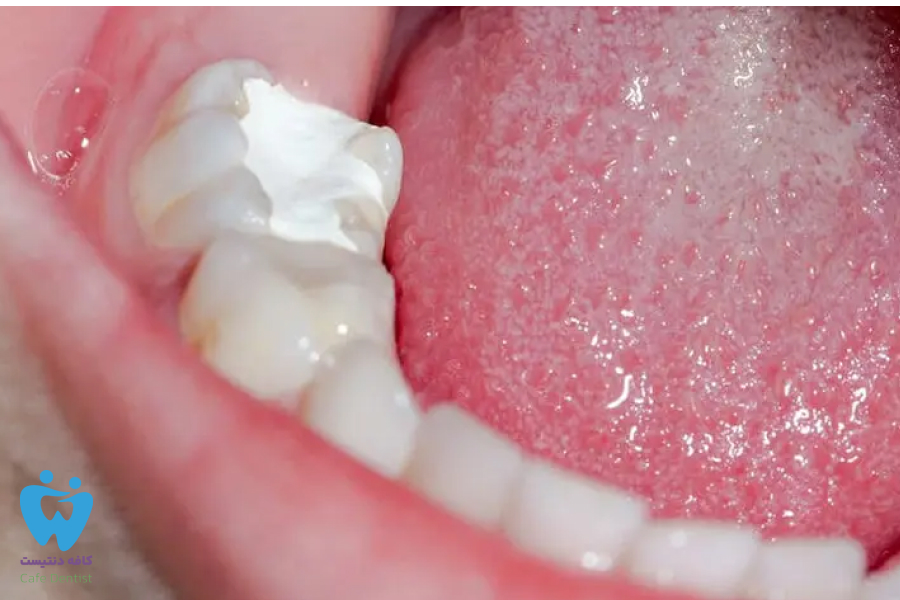 علت درد دندان پانسمان شده