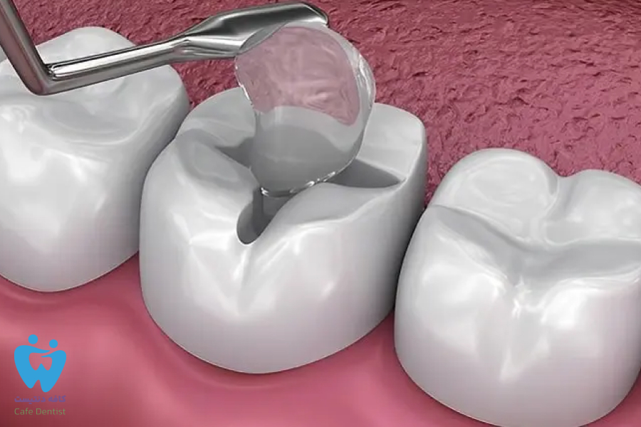 دندان پانسمان شده