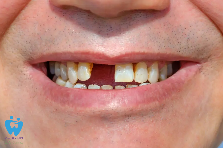 علت لق شدن دندان در بزرگسالی