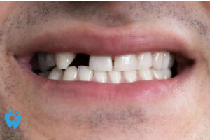 علت لق شدن دندان در بزرگسالی و روش درمان آن