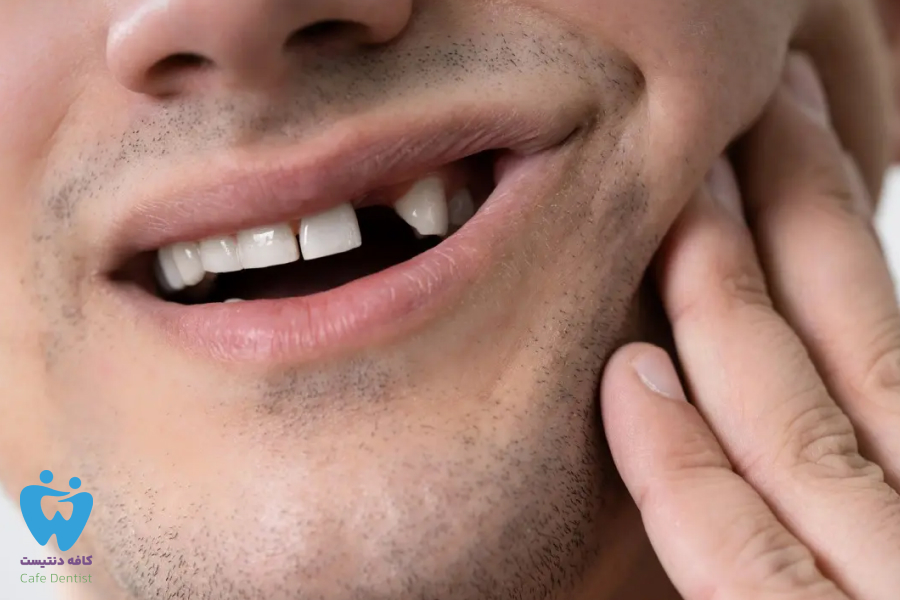 کشیدن دندان لق در بزرگسالی