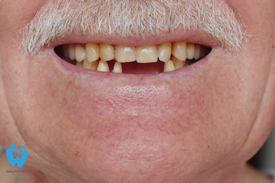 عوارض بی توجهیی به دندان لق شده در بزرگسالی