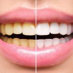 فرق بلیچینگ و کامپوزیت چیست و کدام یک بهتر است؟ 9 بلیچینگ بهتر است یا کامپوزیت
