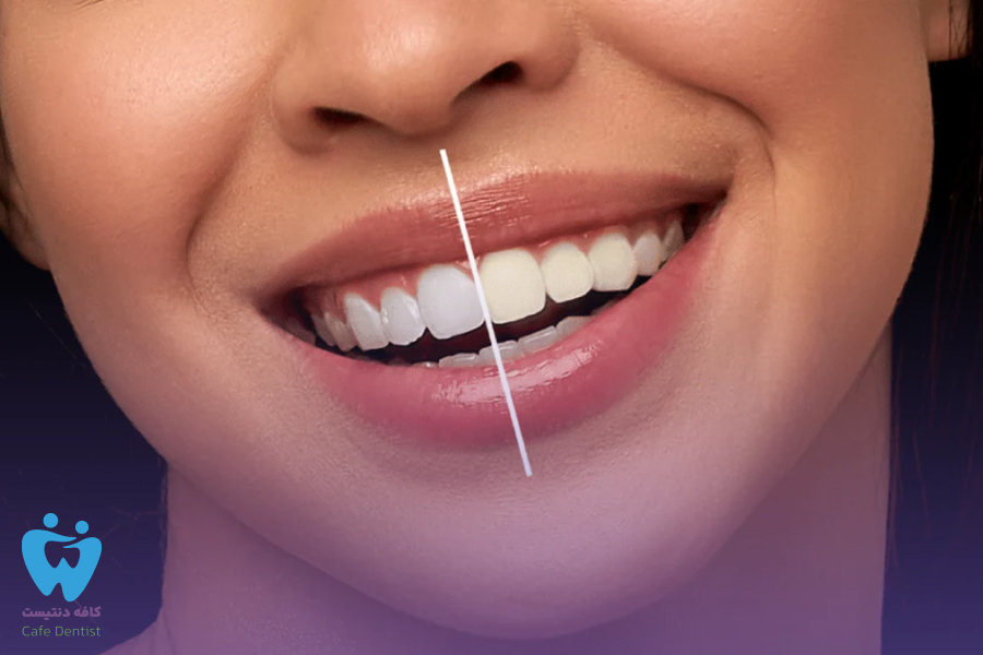 فرق بلیچینگ و کامپوزیت چیست و کدام یک بهتر است؟ 3 بلیچینگ بهتر است یا کامپوزیت