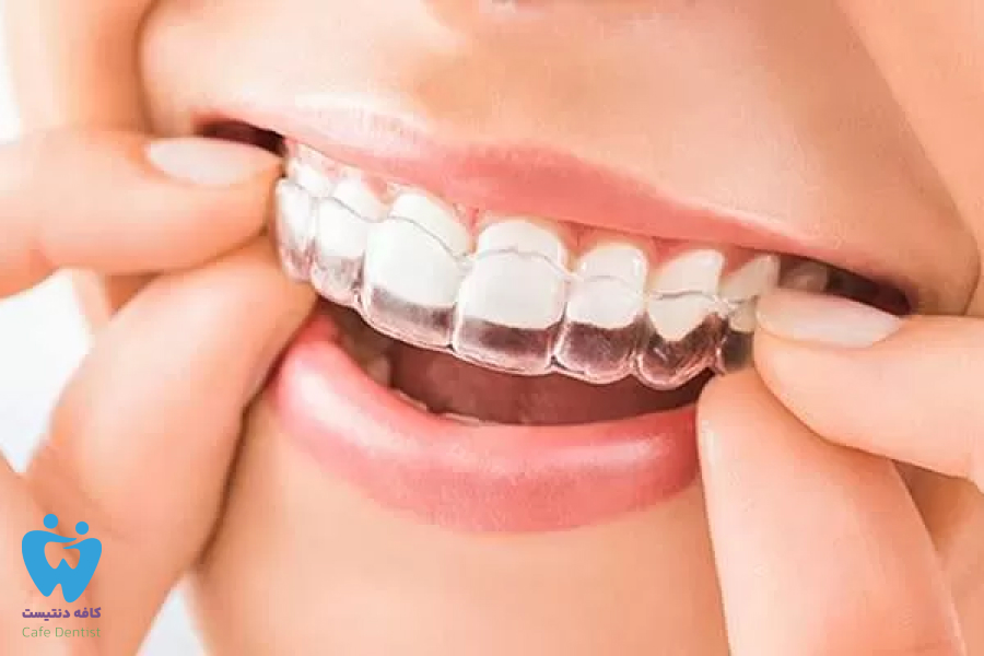 تفاوت نایت گارد سفارشی و آماده